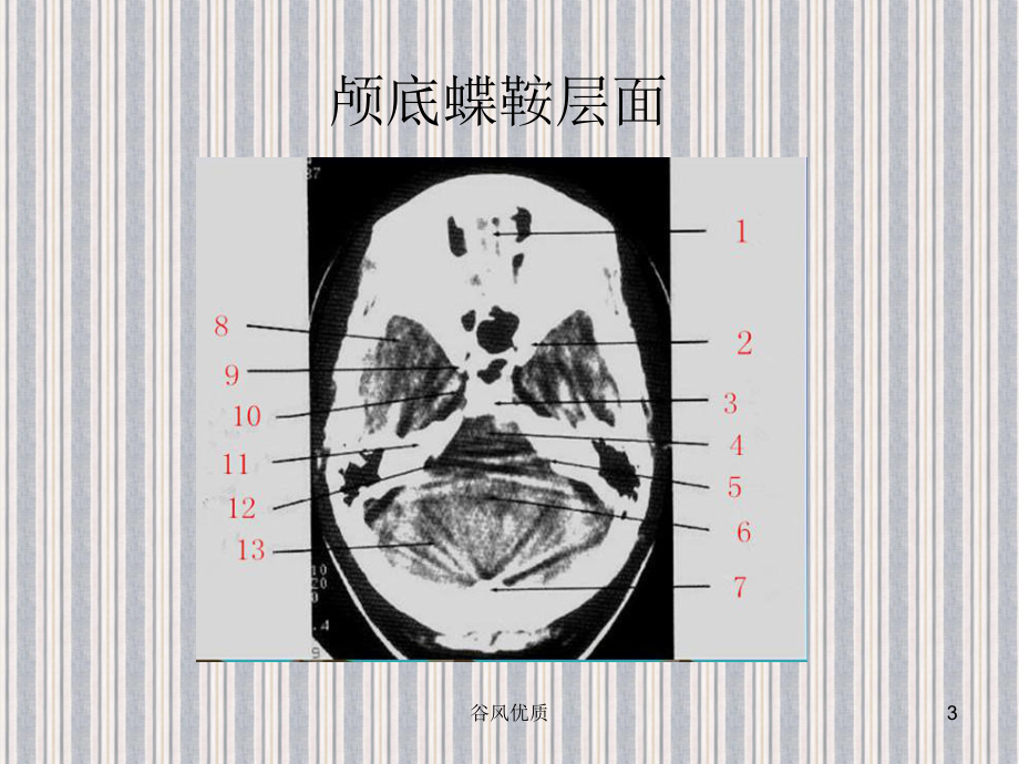 CT断层解剖(行业研究)课件.ppt_第3页