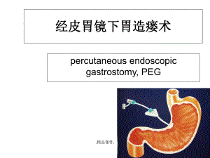 经典经皮胃镜下胃造瘘课件.ppt