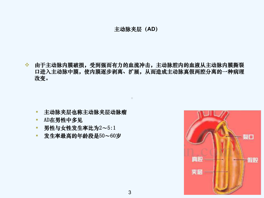 主动脉夹层护理查房0226课件.ppt_第3页