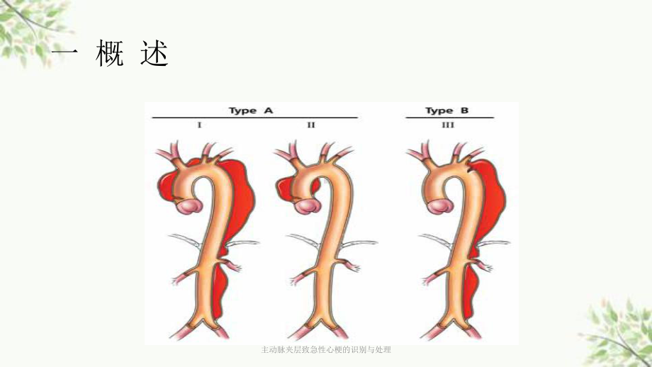 主动脉夹层致急性心梗的识别与处理课件.ppt_第3页