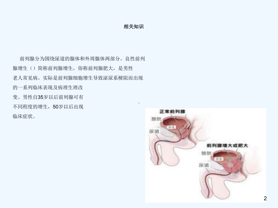 Microsoft-PowerPoint前列腺增生术后护理课件.ppt_第2页