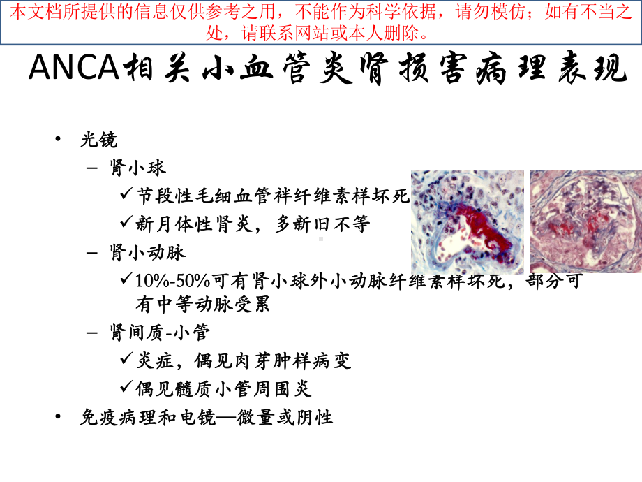 ANCA相关性血管炎肾损害病理表现培训课件.ppt_第3页