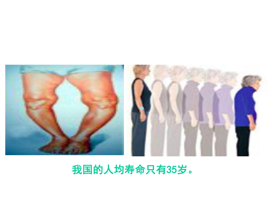 骨关节的危害课件.ppt_第3页