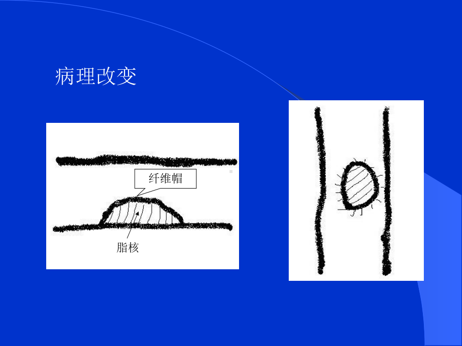 16层螺旋CT冠脉成像课件.ppt_第3页