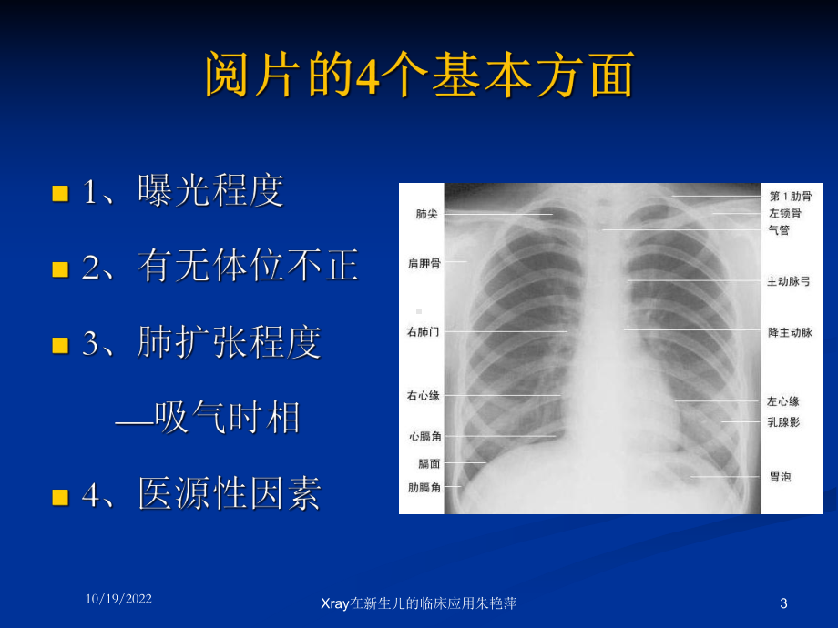 Xray在新生儿的临床应用培训课件.ppt_第3页