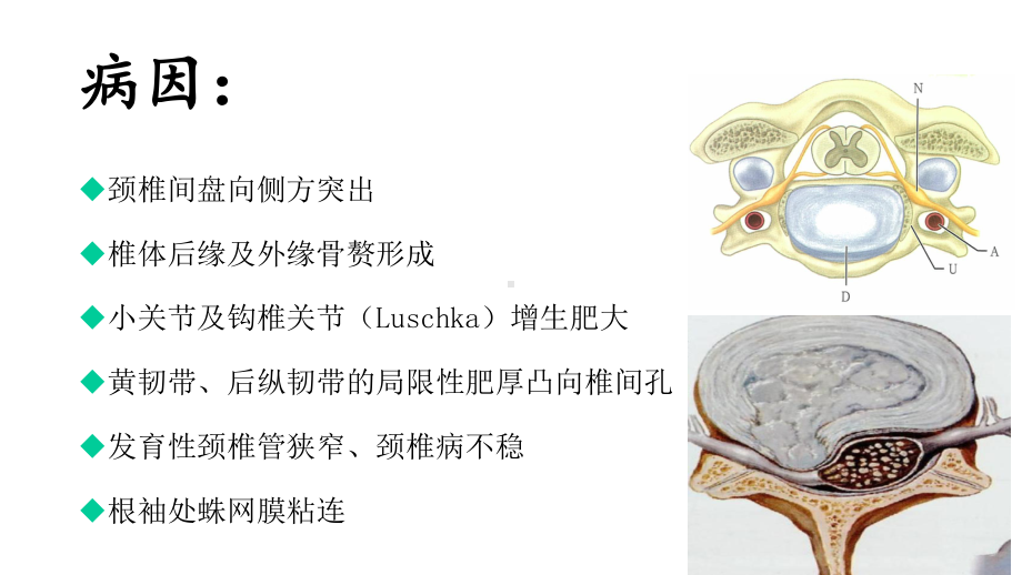 神经根型颈椎病的诊断与鉴别诊断课件.ppt_第3页