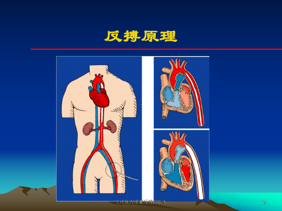 主动脉内球囊反博的临床课件.ppt_第2页