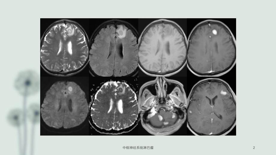 中枢神经系统淋巴瘤课件.pptx_第2页