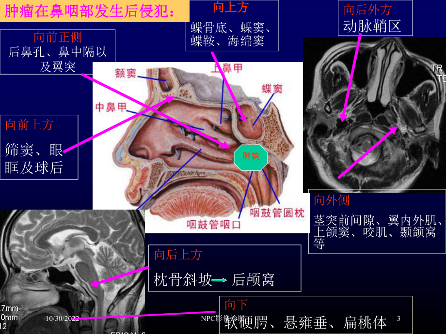 NPC影像诊断培训课件.ppt_第3页