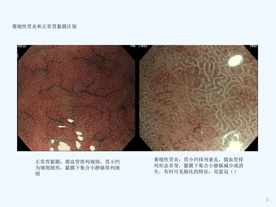 NBIME诊断早期胃癌技巧课件.ppt_第3页