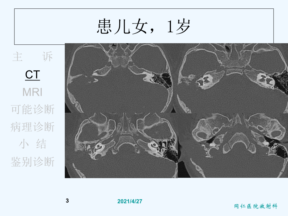 LCH的诊断与鉴别诊断课件.ppt_第3页