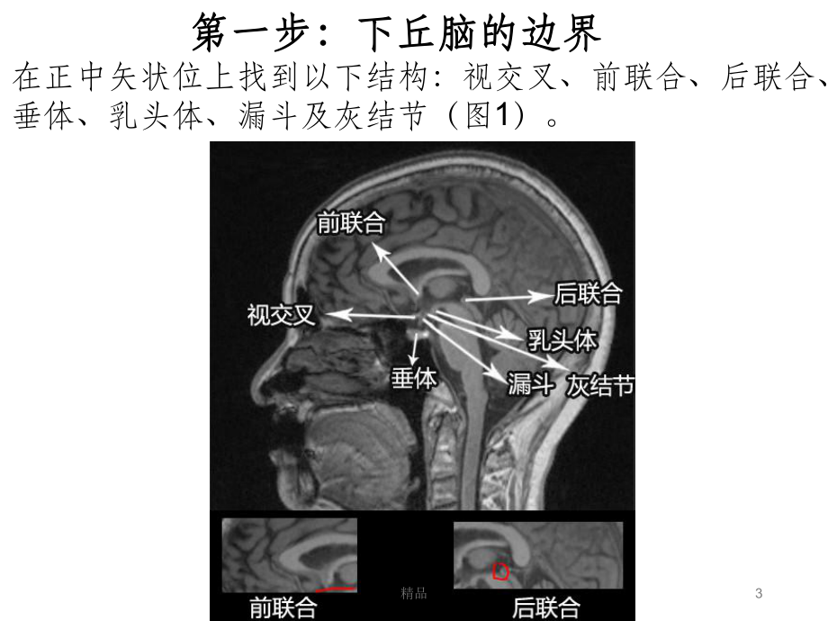 下丘脑影像解剖课件.ppt_第3页