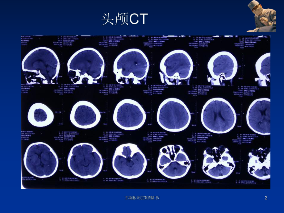 主动脉夹层案例汇报培训课件.ppt_第2页