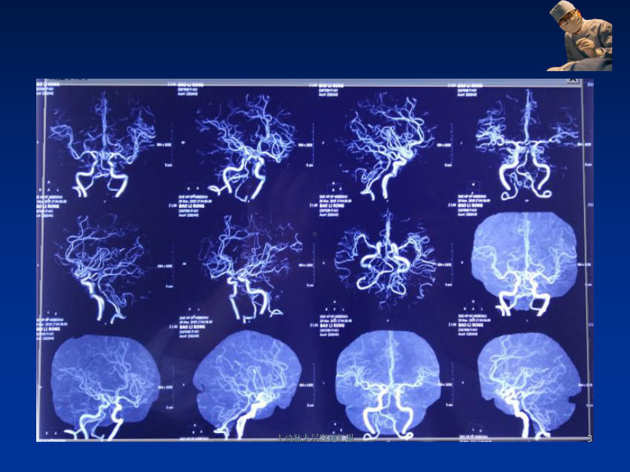 主动脉夹层案例汇报培训课件.ppt_第3页