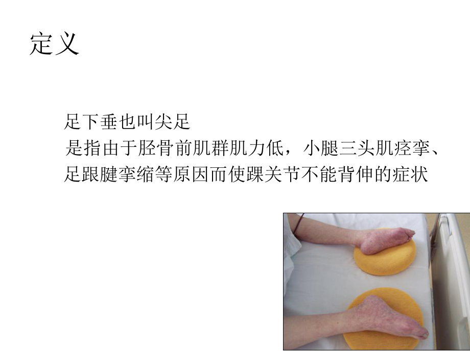 足下垂的预防及护理课件.ppt_第2页