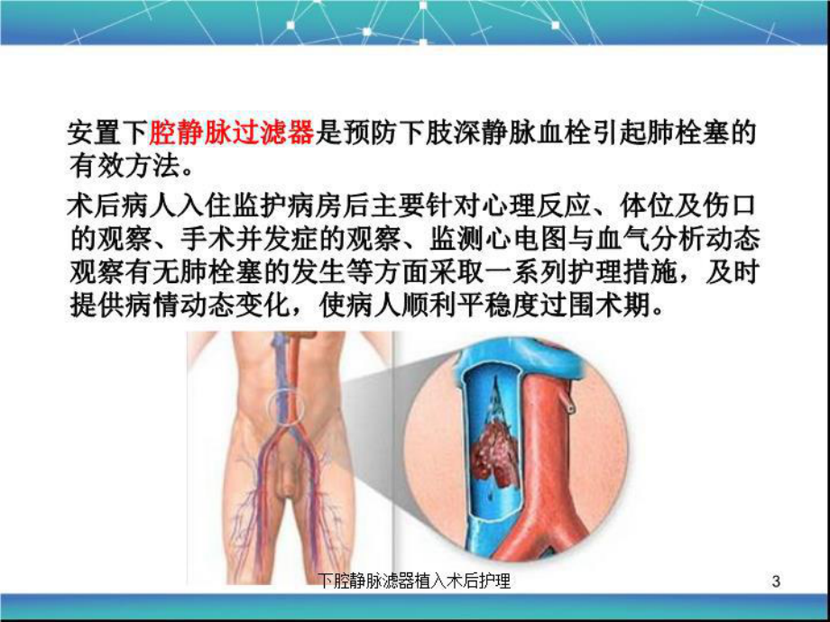 下腔静脉滤器植入术后护理培训课件.ppt_第3页