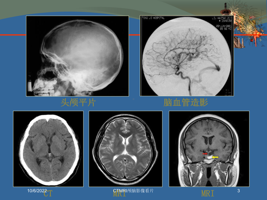 CTMRI颅脑影像看片培训课件.ppt_第3页