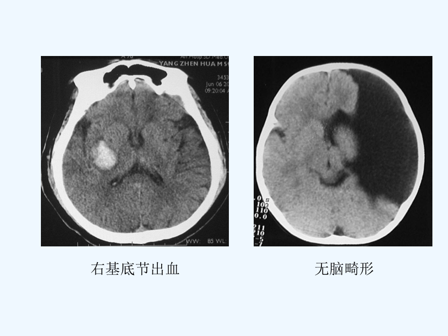 CT检查的适应证与禁忌证课件.ppt_第3页