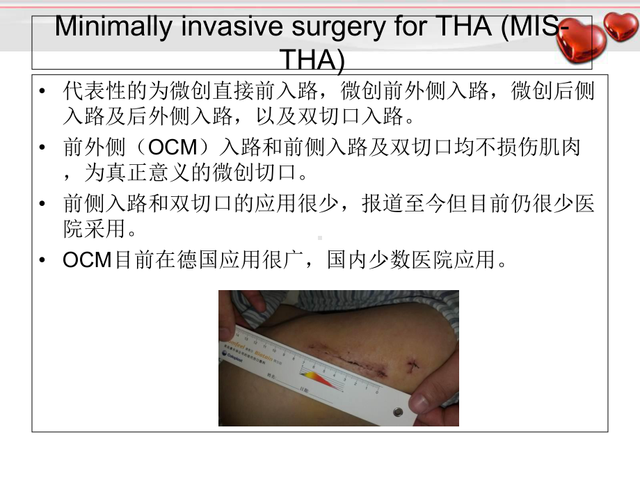 OCM入路小切口全髋关节置换教学课件.ppt_第3页