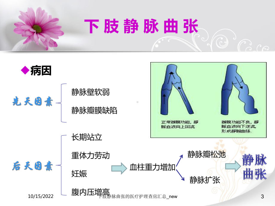 下肢静脉曲张的医疗护理查房汇总-new课件.ppt_第3页