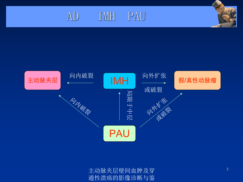 主动脉夹层壁间血肿及穿通性溃疡的影像诊断与鉴别诊断培训课件.ppt_第3页