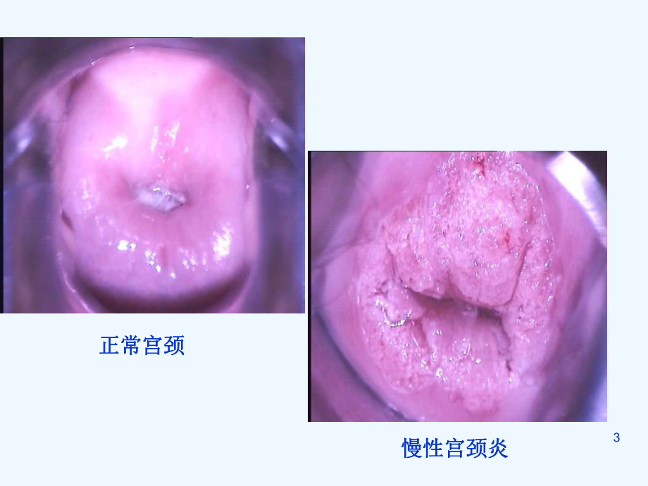 中西医结合宫颈炎症课件.ppt_第3页