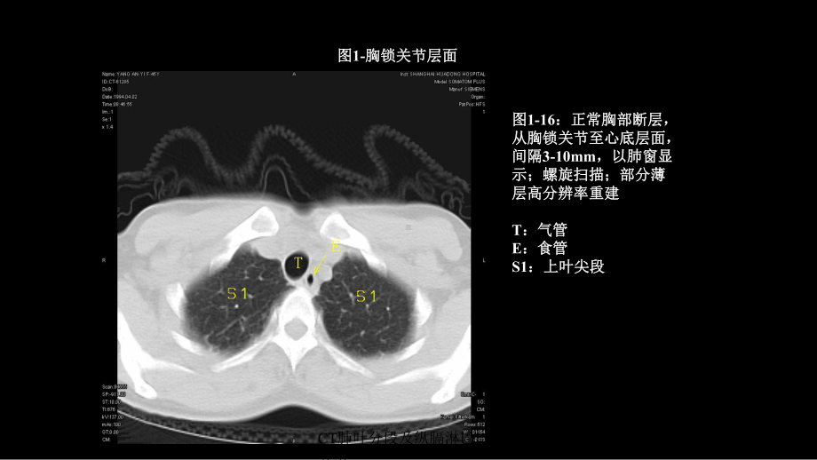 CT肺叶分段及纵膈淋巴结分组培训课件.ppt_第1页