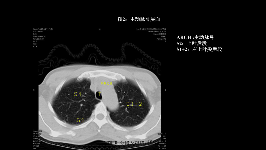 CT肺叶分段及纵膈淋巴结分组培训课件.ppt_第2页