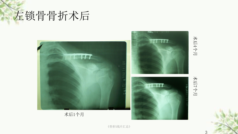 《骨折X线片汇总》课件.ppt_第3页