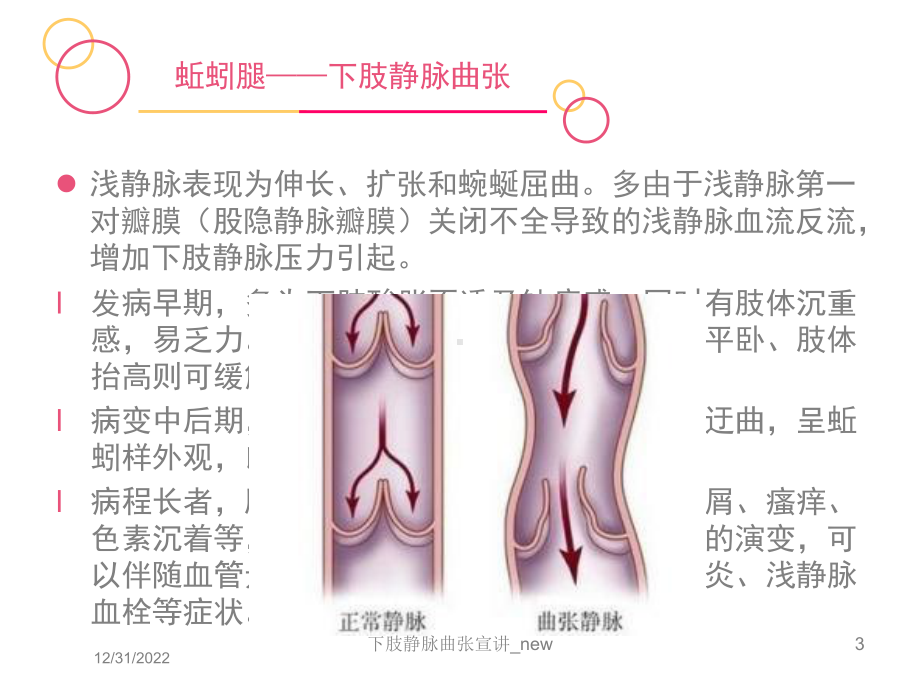 下肢静脉曲张宣讲-new课件.ppt_第3页