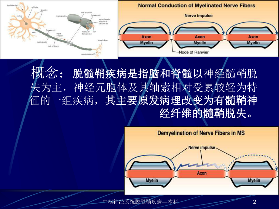 中枢神经系统脱髓鞘疾病—本科课件.ppt_第2页