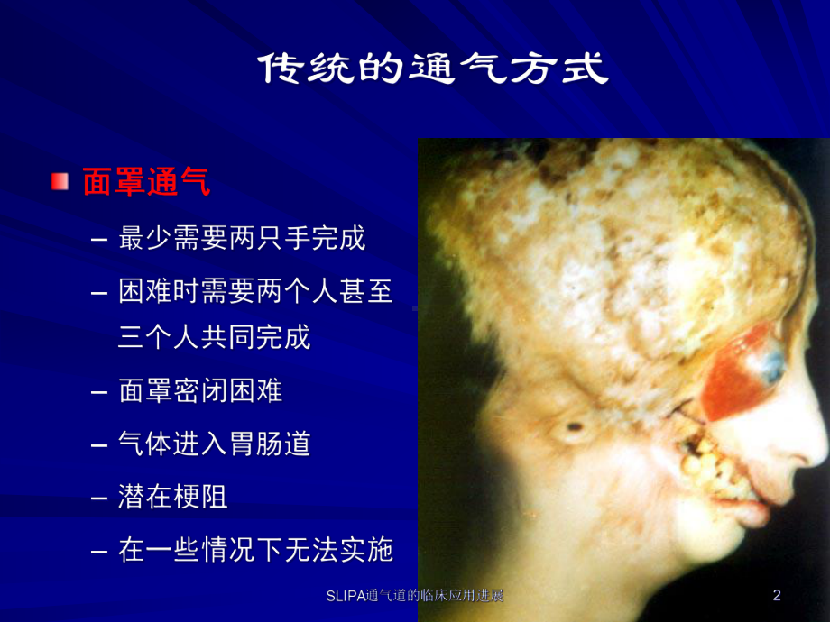 SLIPA通气道的临床应用进展课件.ppt_第2页