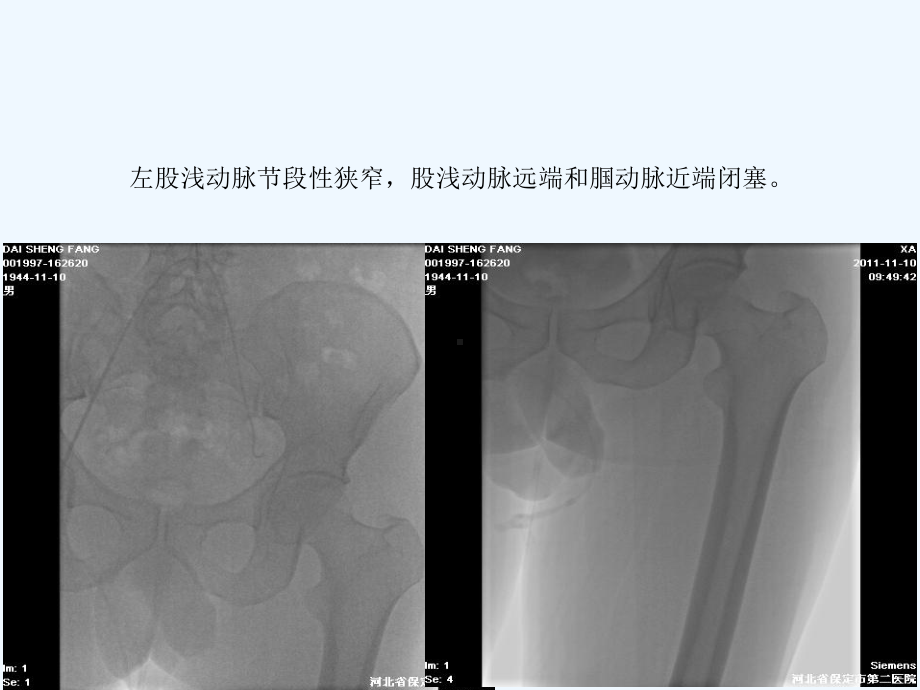 下肢动脉硬化闭塞症的腔内治疗课件.ppt_第3页