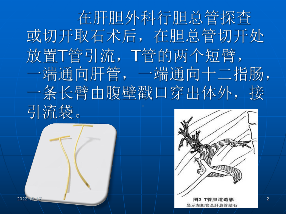 T管引流护理参考课件.ppt_第2页