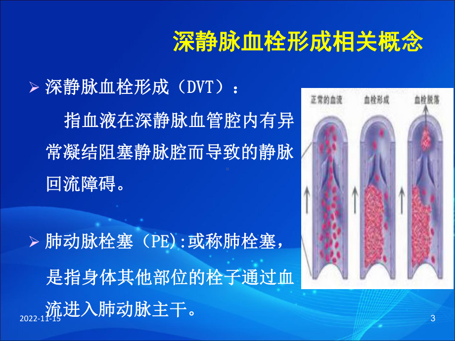 下肢深静脉血栓形成的防治指南参考课件.ppt_第3页