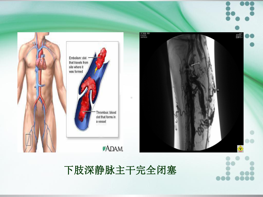 下肢深静脉血栓护理(修改稿)课件.ppt_第3页