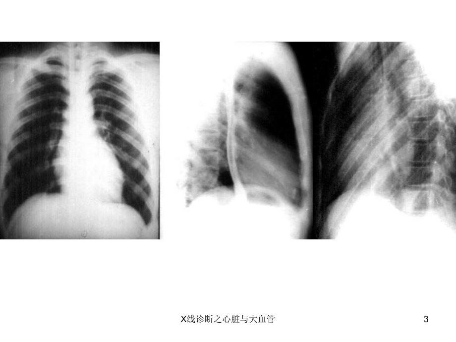 X线诊断之心脏与大血管课件.ppt_第3页