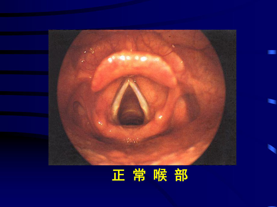 七年制医学耳鼻喉4喉癌课件.pptx_第3页