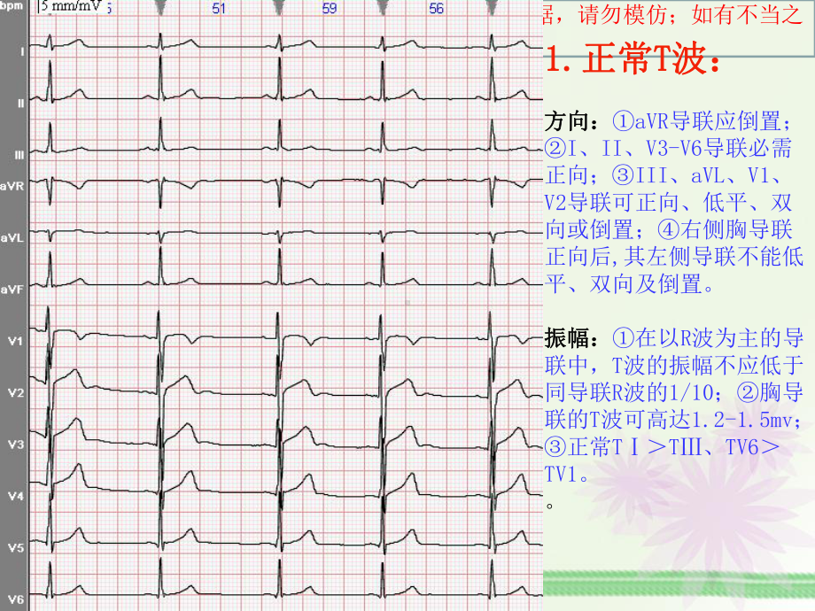 T波改变的临床意义培训课件.ppt_第2页