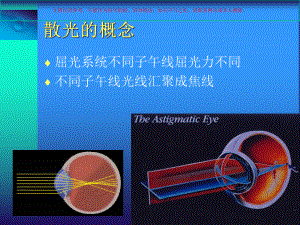 ToricICL植入矫正高度近视散光培训课件.ppt