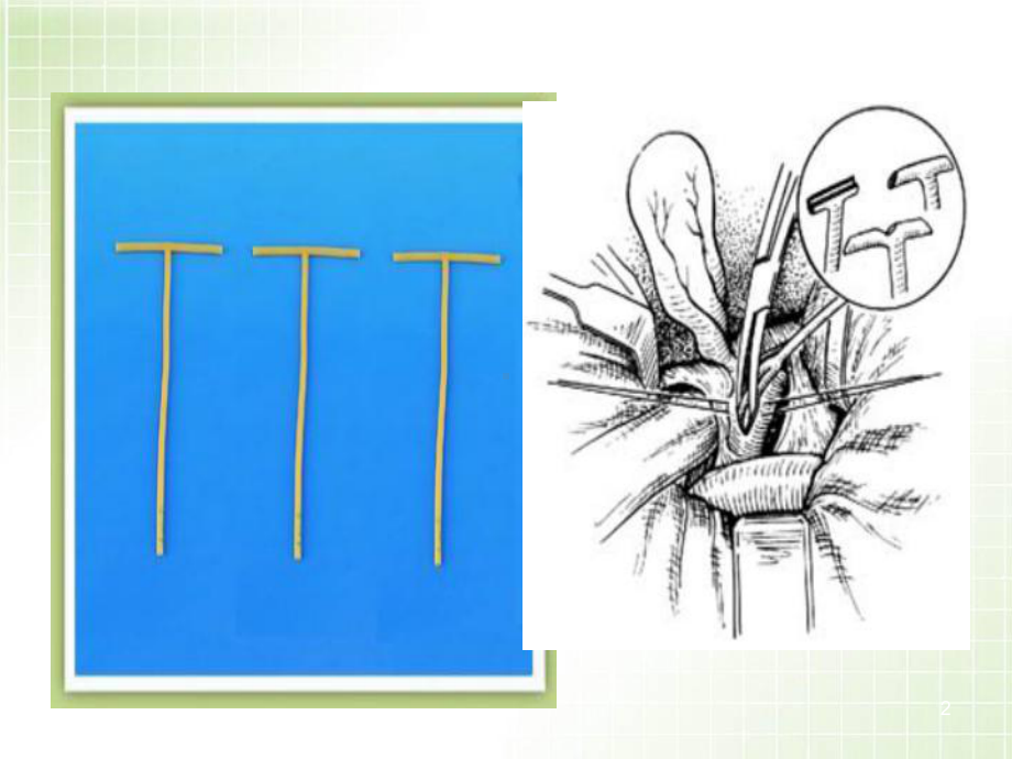 T管引流的护理优质课件.ppt_第2页