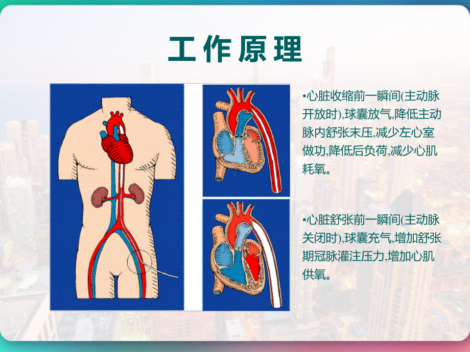 IABP主动脉内球囊反搏泵置管术-课件.pptx_第3页