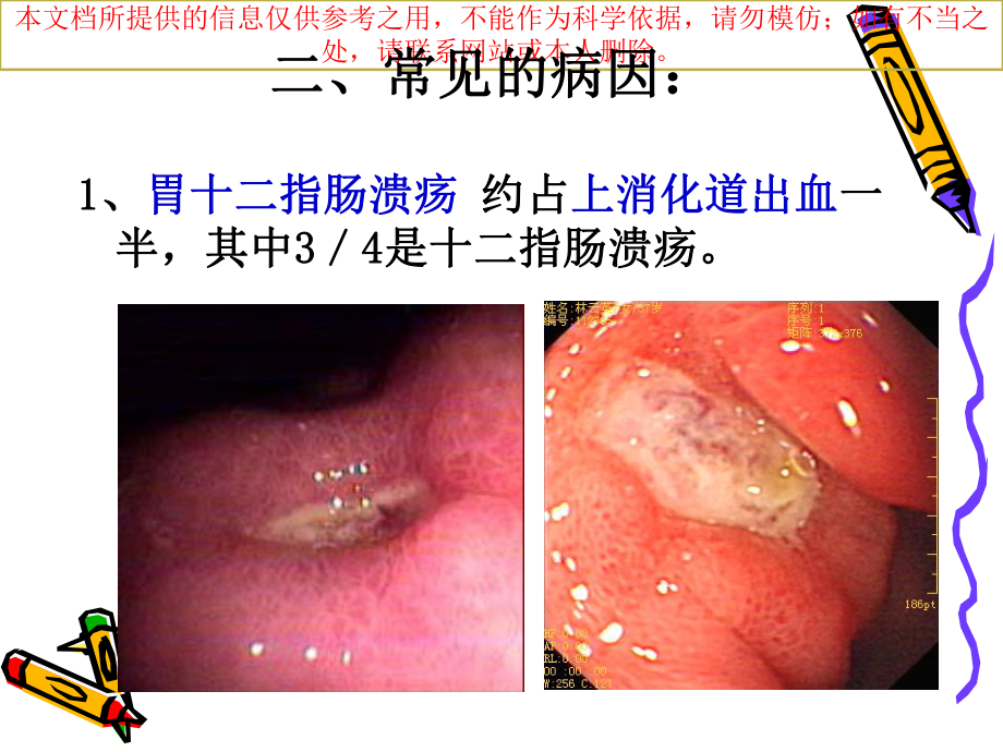 上消化道出血病人的观察和医疗护理培训课件.ppt_第3页