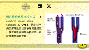 一例颅内静脉窦血栓形成病人的护理培训课件.ppt