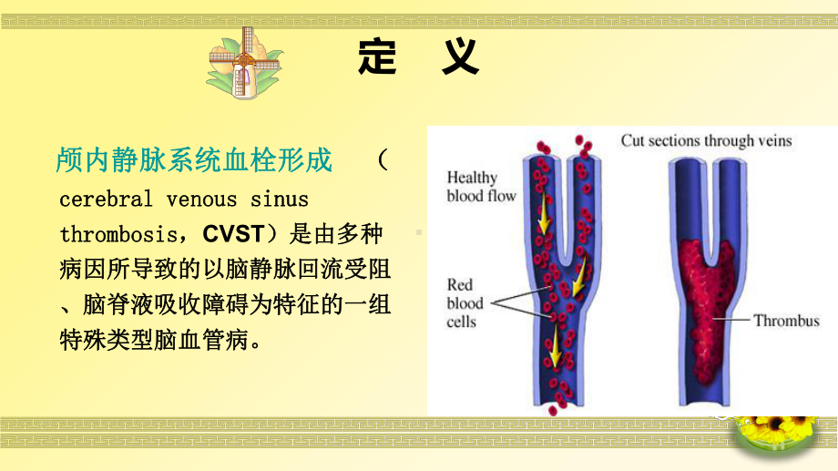 一例颅内静脉窦血栓形成病人的护理培训课件.ppt_第1页