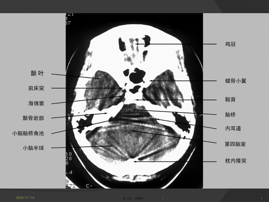 中枢神经系统肿瘤影像诊断课件.ppt_第3页