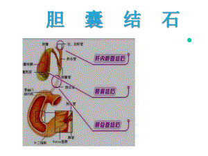 胆囊结石护理课件.ppt