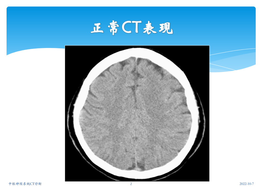 中枢神经系统CT诊断课件.ppt_第2页