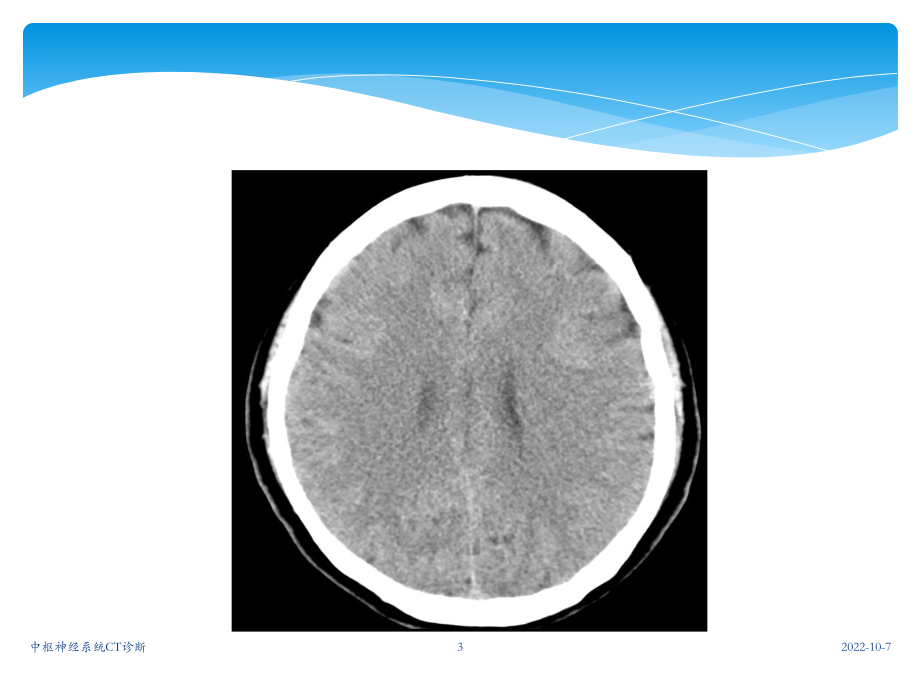 中枢神经系统CT诊断课件.ppt_第3页