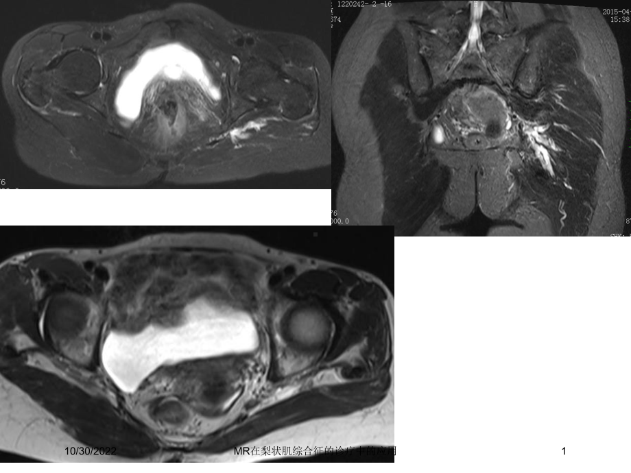 MR在梨状肌综合征的诊疗中的应用培训课件.ppt_第1页